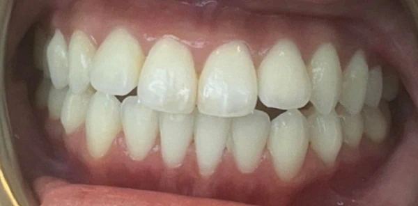 After — case 2
