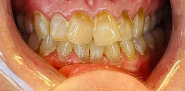 Before — case 6