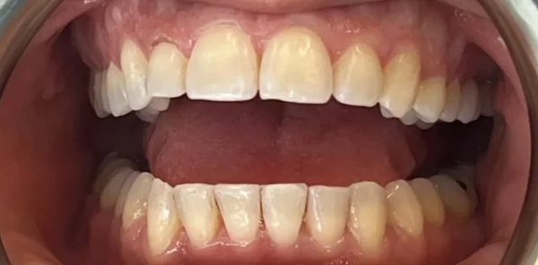 After — case 11