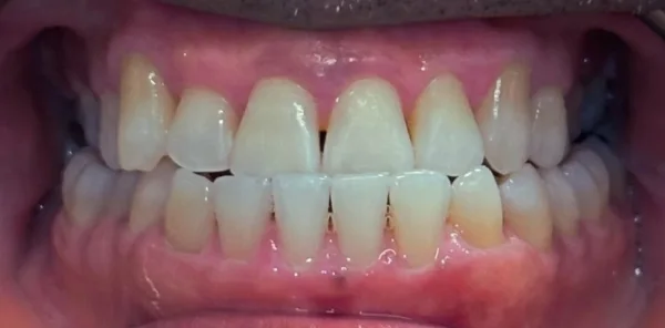 After — case 13