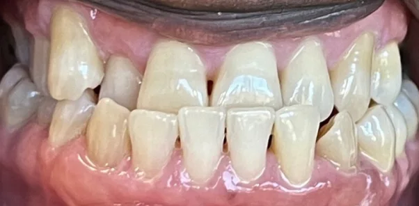 Before — case 13