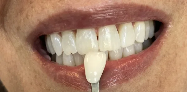 After — case 14
