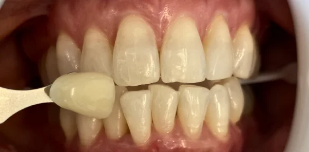 Before — case 14
